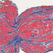 Pinching artefact endomyoardial biopsy trichrome 75 x 75